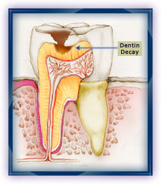 Cavities in Dentin Layer of Tooth 